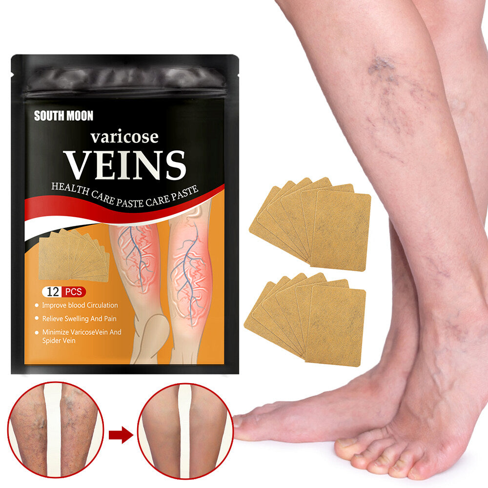 Natural Remedy for Varicose Veins