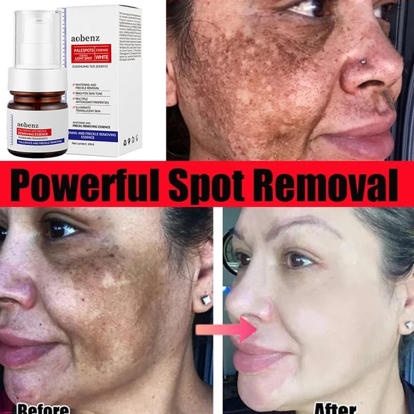 NO.1 MELASMA TREATMENT SERUM