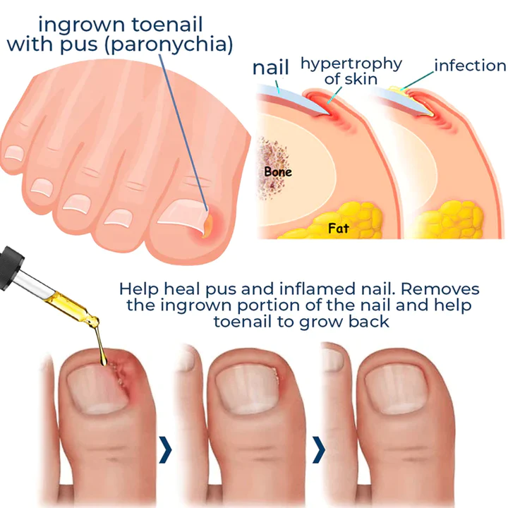 German ToenailCare™ Removal Paronychia Oil - Nuskin Beauty Store