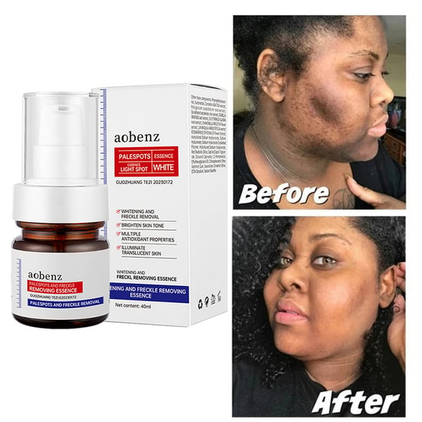 NO.1 MELASMA TREATMENT SERUM