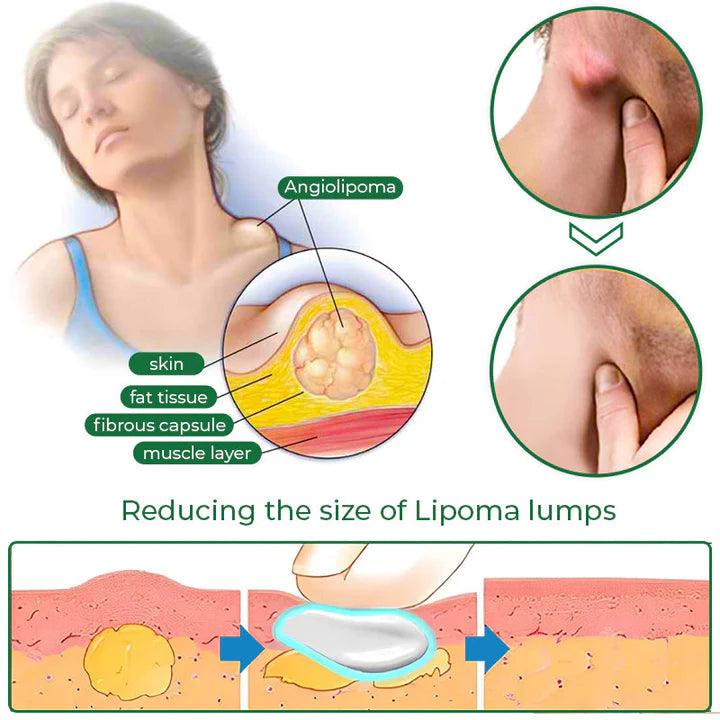 LipomaCure™ Soothing Ointment - Nuskin Beauty Store